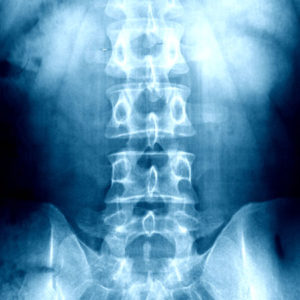 Myelography Spinal Xray