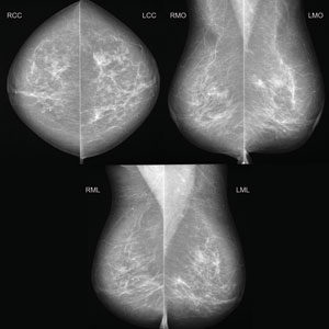 diagnostic mammography