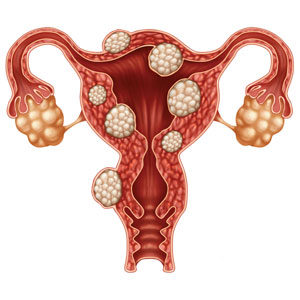 uterine fibroid embolization ufe